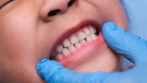 Cum să preveniți demineralizarea dinților la copii: Ghid pentru părinți